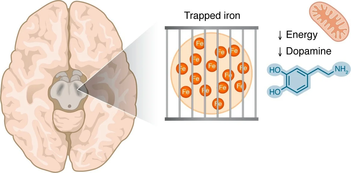 Iron accumulation in the substantia nigra is visible by MRI techniques in patients with PD. This iron may be in a trapped form, making it unavailable for the iron-dependent biological processes that are critical in dopaminergic cells, including mitochondrial respiration and dopamine synthesis.