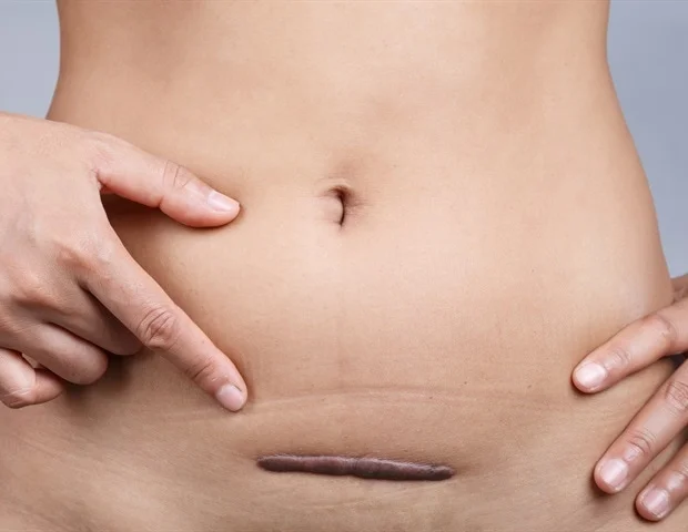 קולגן לא סדיר בצלקות הרחם הקשורות להתפתחות שליה