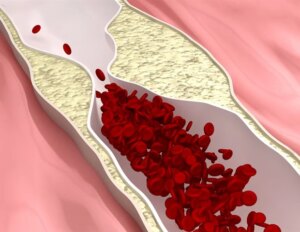 Evolocumab מפחית אירועים לבביים בחולי סוכרת בסיכון גבוה