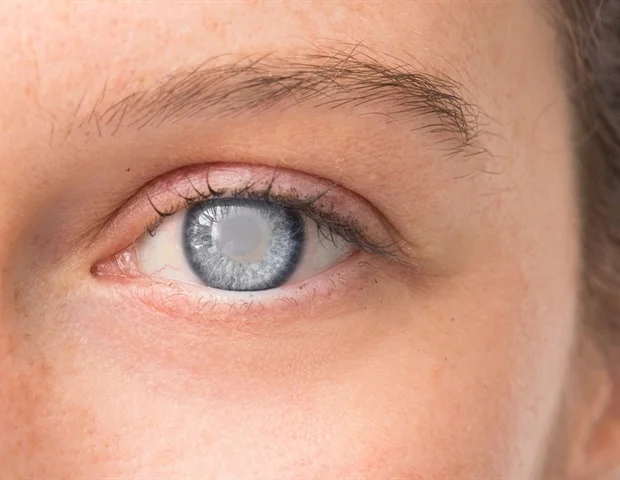 רופא עיניים הר סיני חושף כלי פורץ דרך לניטור נוזלי עיניים