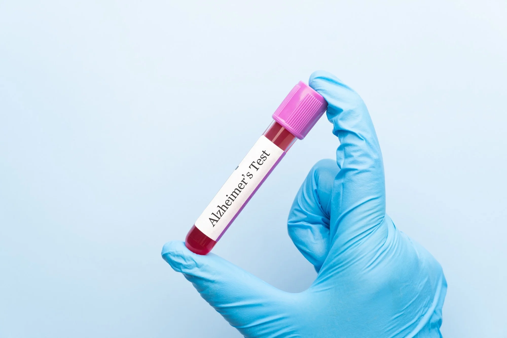 Blood sample tube with Alzheimer test label on medical laboratory technologist hands over blue background