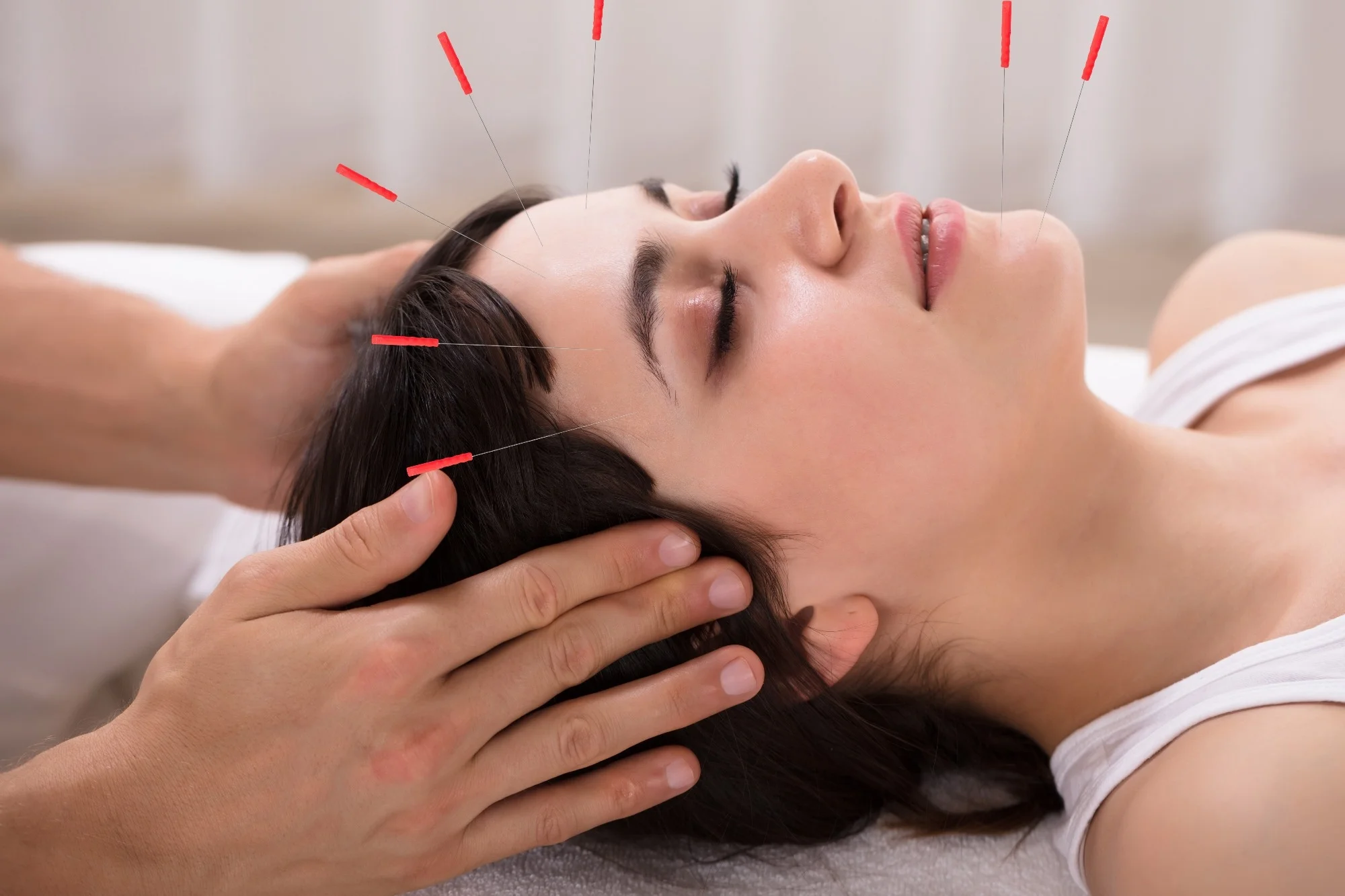 Relaxed Young Woman Receiving Acupuncture Treatment
