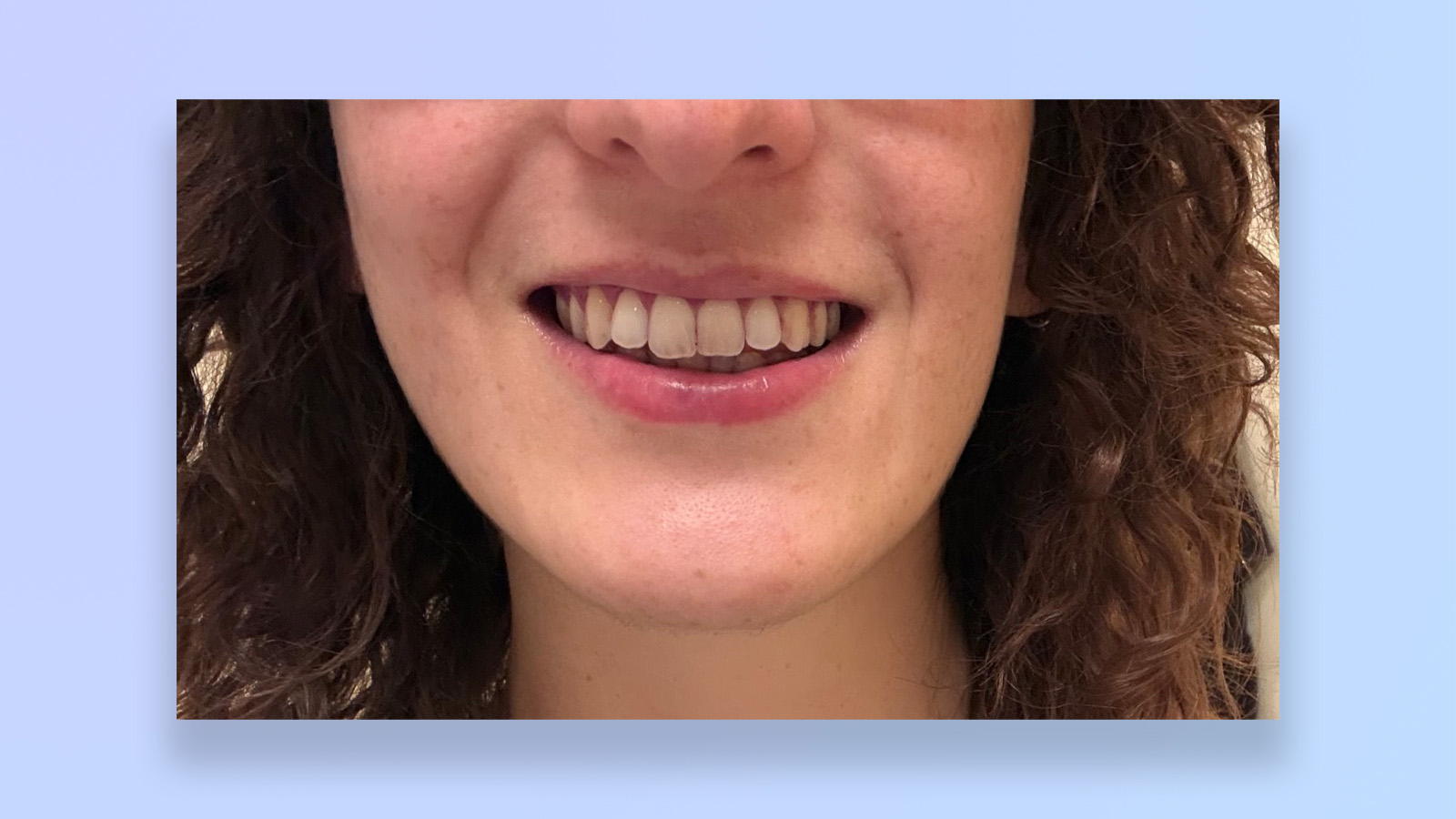 תמונה של שיניו של המחבר לפני/אחרי השימוש במברשת השיניים suri core 1.0