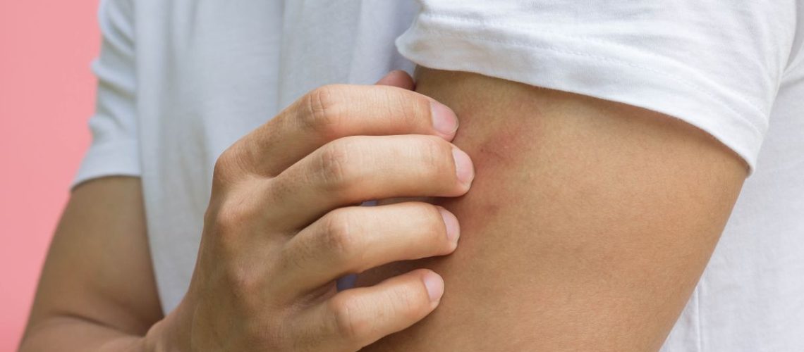 Man scratching bug bite on arm