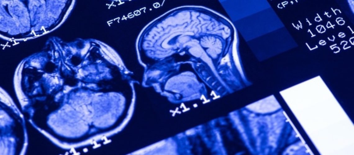 חומצות שומן אומגה 3 מראות פוטנציאל בהגנה על בריאות המוח אצל מבוגרים