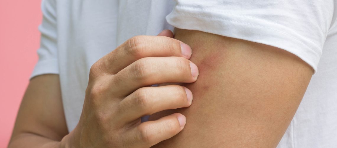 Man scratching bug bite on arm