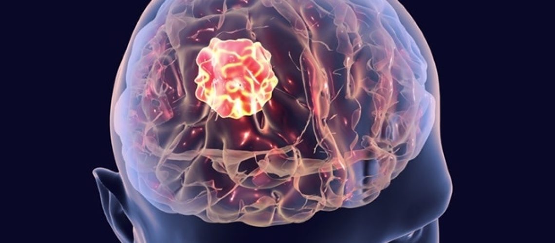 AI יכול לחזות שורדים לטווח קצר ולטווח ארוך של סרטן המוח