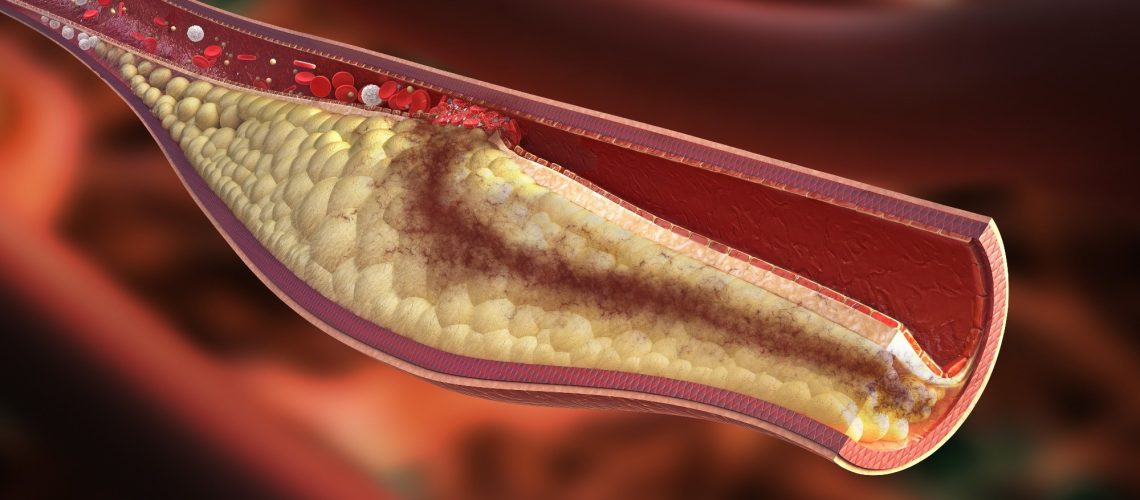 Study: SARS-CoV-2 Infection Association with Atherosclerotic Plaque Progression at Coronary CT Angiography and Adverse Cardiovascular Events. Image Credit: Rocos / Shutterstock