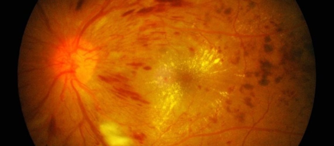 Exonate טיפת עיניים ראשונה מסוגה נתוני ניסוי שלב Ib/IIa מדגימים בטיחות ופעילות ביולוגית בטיפול ברטינופתיה סוכרתית ובבצקת מקולרית סוכרתית