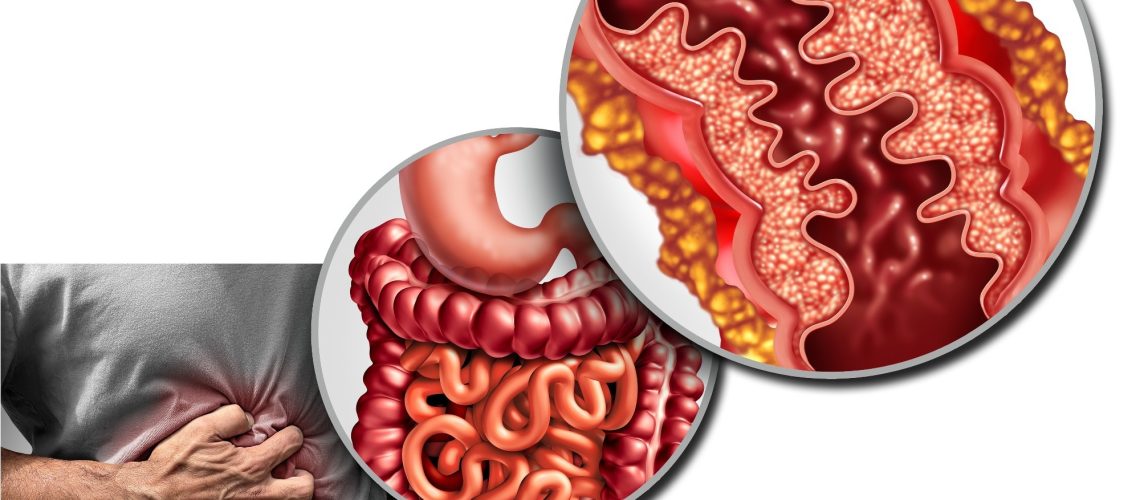 Study: Efficacy and safety of filgotinib as induction and maintenance therapy for Crohn