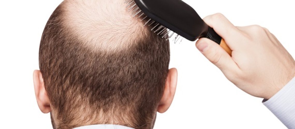 Finasteride עשוי להציע יתרונות מצילי חיים מעבר לטיפול בנשירת שיער