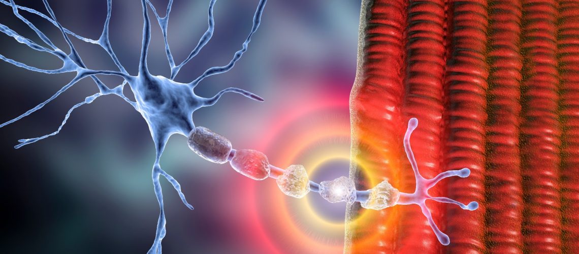 Demyelination of neuron, the damage of the neuron myelin sheath seen in demyelinating diseases. Image Credit: Kateryna Kon / Shutterstock