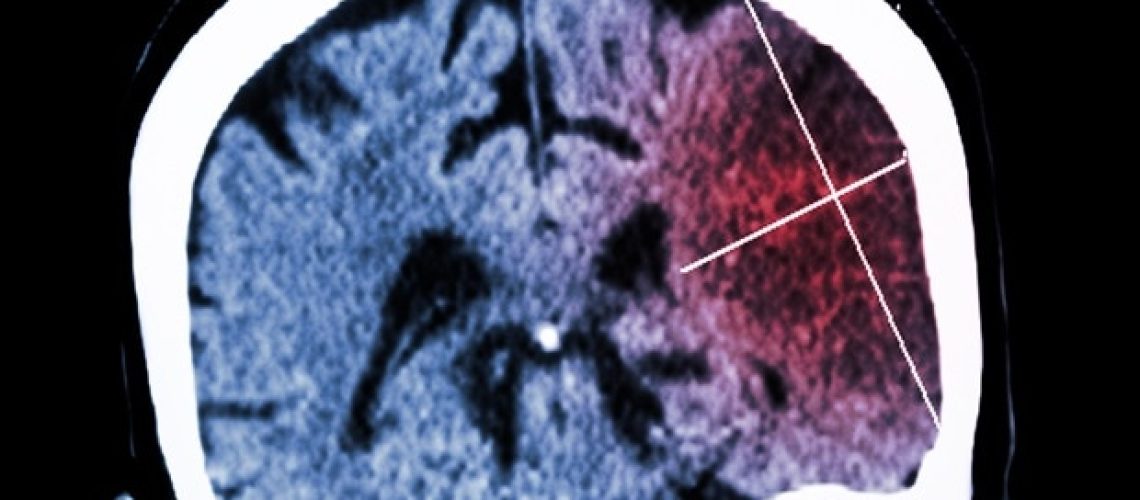 אגרגטים פוליגליצין משבשים את שחבור ה- tRNA ומניעים את התנוונות העצבים