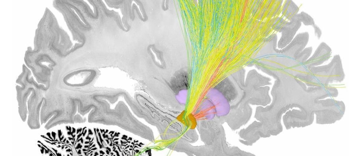 New algorithm enhances deep brain stimulation for Parkinson