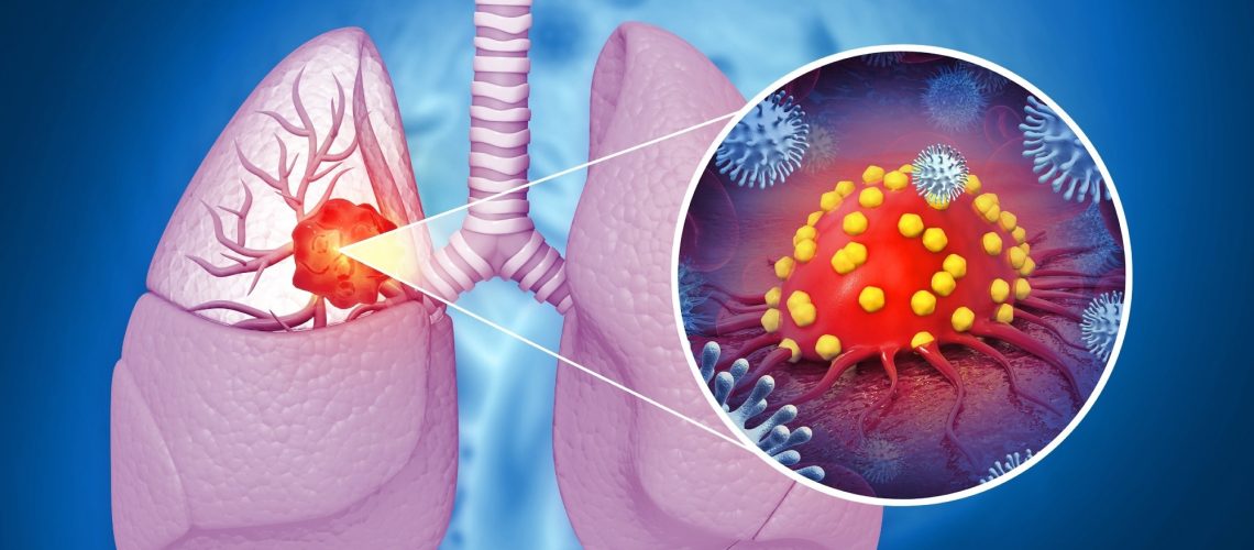 Review: Correlation between allergic diseases and lung cancer: a systematic review and meta-analysis. Image Credit: crystal light  / Shutterstock