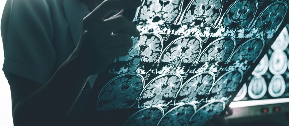 Study: Plasma Phosphorylated Tau 217 to Identify Preclinical Alzheimer Disease. Image Credit: Atthapon Raksthaput / Shutterstock