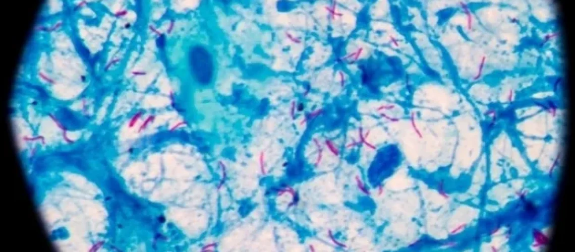 ארגון הבריאות העולמי דורש גילוי מהיר יותר של שחפת עם בדיקות נקודת טיפול חדשות