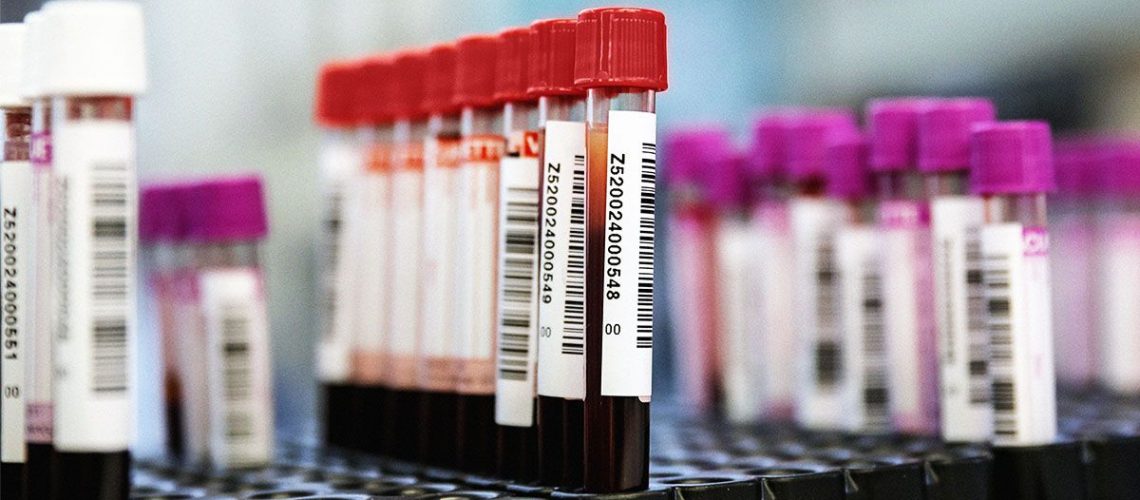 בדיקת דם חדשה מראה הבטחה מסוימת בגילוי סרטן המעי הגס