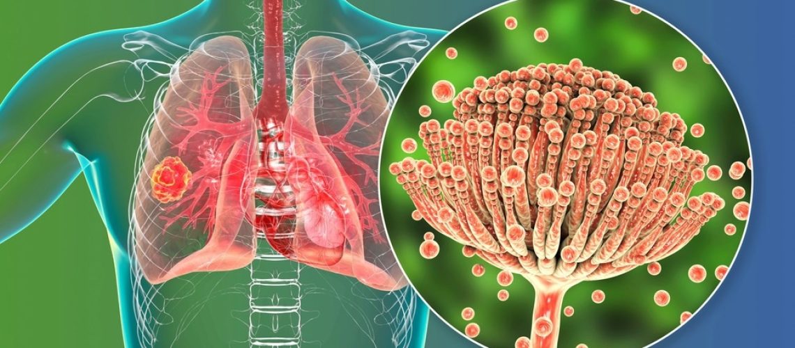 Study: Mortality in chronic pulmonary aspergillosis: a systematic review and individual patient data meta-analysis. Image Credit: Kateryna Kon/Shutterstock.com