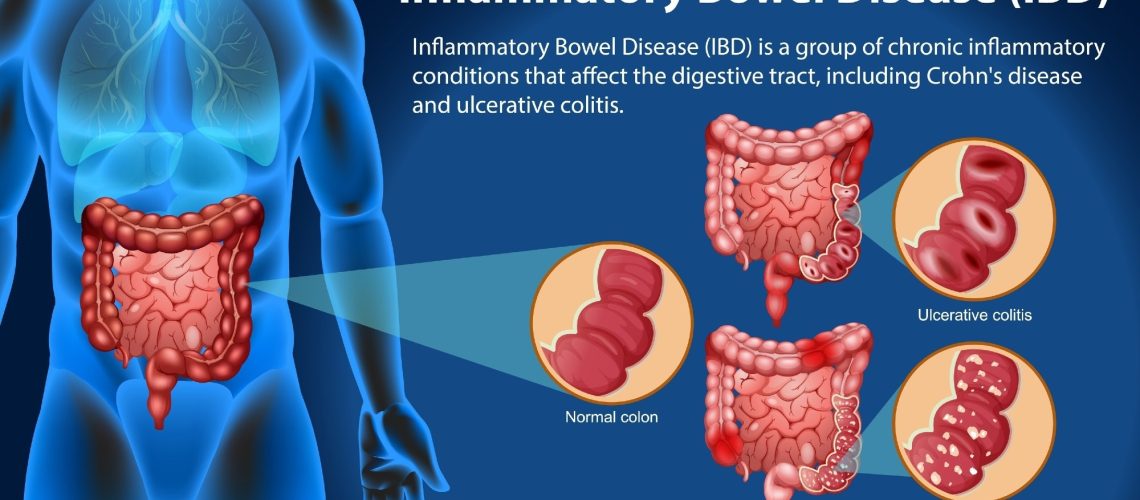Review: Systems biology to unravel Western diet-associated triggers in inflammatory bowel disease. Image Credit: BlueRingMedia / Shutterstock