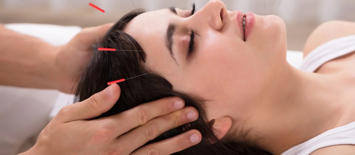 Relaxed Young Woman Receiving Acupuncture Treatment