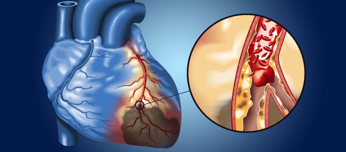 Study: Inflammatory risk and cardiovascular events in patients without obstructive coronary artery disease: the ORFAN multicentre, longitudinal cohort study. Image Credit: Axel_Kock / Shutterstock.com