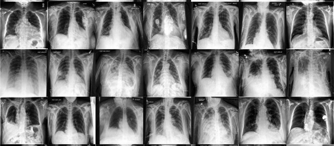 Study: Generative models improve fairness of medical classifiers under distribution shifts
