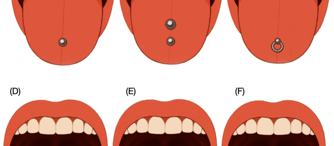 Schematic diagram illustrating the most common sites for tongue piercings. (A) Single middle tongue; (B) double piercing in midline; (C) ring piercing; (D,E) double piercing horizontally and (F) multiple piercing usually involving two or more piercings arranged in a row or symmetrically on either side of the midline.