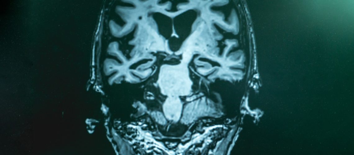 Alzheimer