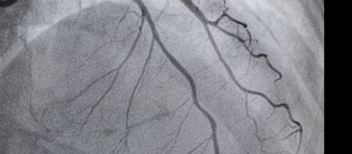 הדמיה תוך-וסקולרית משפרת את ההישרדות בחולי מחלות לב העוברים הצבת סטנטים