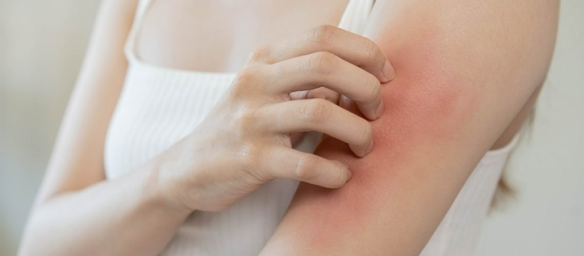 Study: Impact of climate change on atopic dermatitis: A review by the International Eczema Council. Image Credit: Kmpzzz/Shutterstock.com