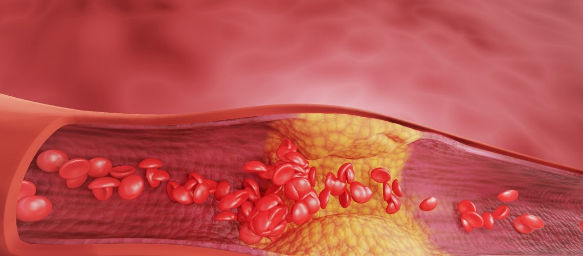 atherosclerosis, and heart disease problems in human blood vessels. 3D rendering