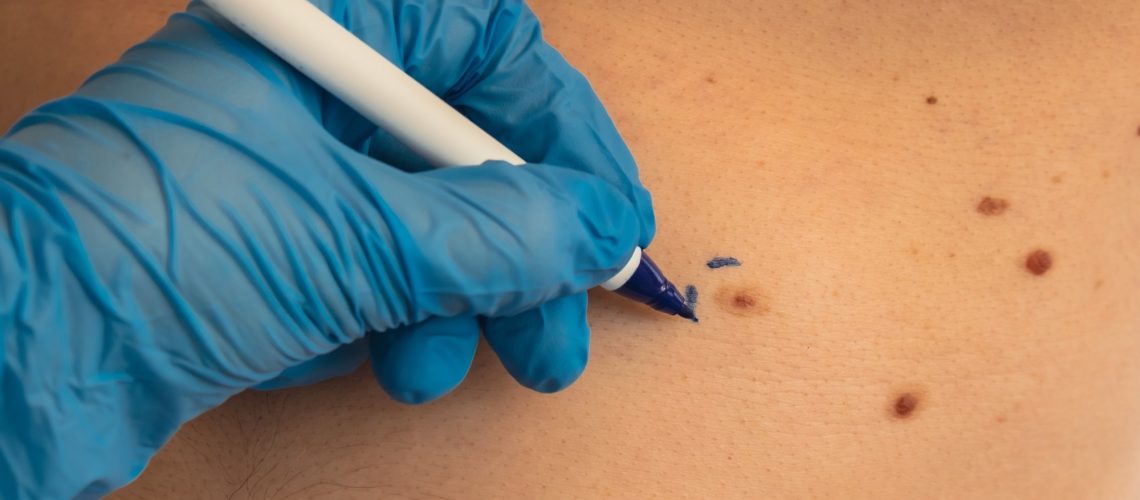 Study: Nicotinamide for Skin Cancer Chemoprevention. Image Credit: yanishevska / Shutterstock