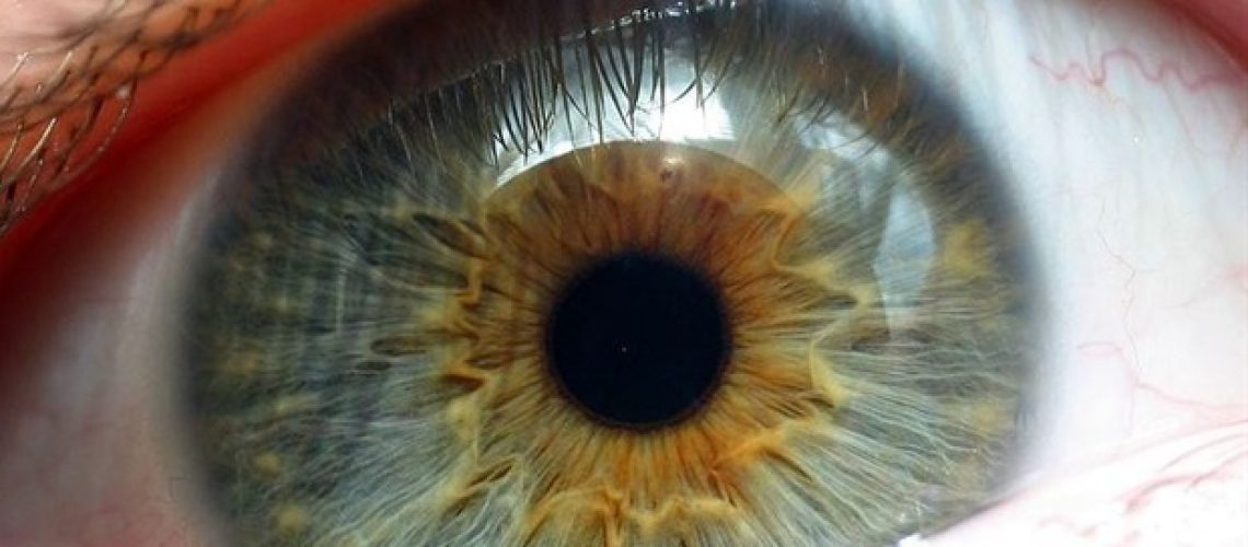 המחקר מרמז על גישה מבטיחה לטיפול בניוון מקולרי רטוב הקשור לגיל