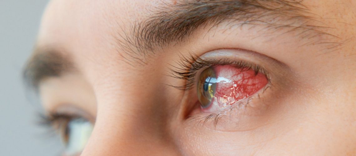 Study: Harmol used for the treatment of herpes simplex virus induced keratitis. Image Credit: STEKLO/Shutterstock.com