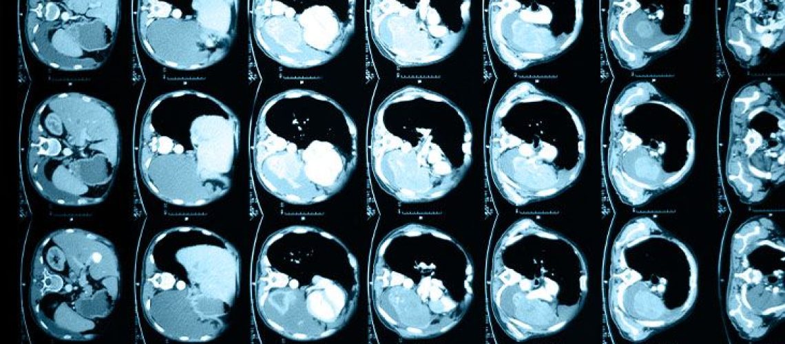 השמנת יתר עלולה להשפיע על תהליכים מטבוליים ותפקודי כבד, כך עולה ממחקר