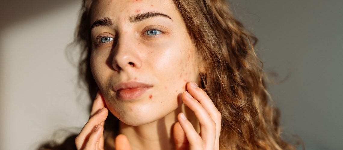 Study: Impact of Diet and Nutrition in Patients with Acne Vulgaris. Image Credi: maxbelchenko / Shutterstock.com