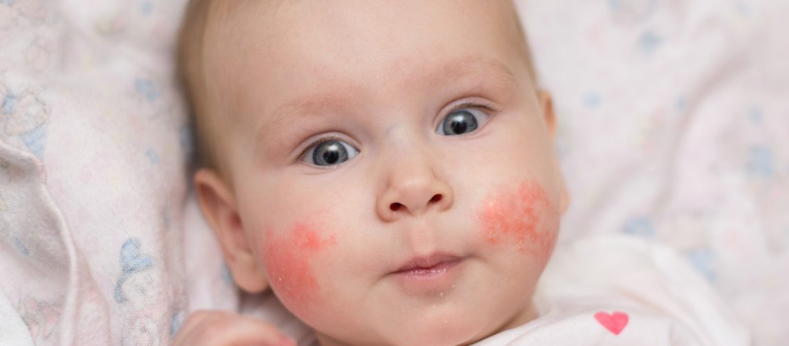 Study: Vitamin D level is inversely related to allergen sensitization for risking atopic dermatitis in early childhood. Image Credit: alexeisido / Shutterstock