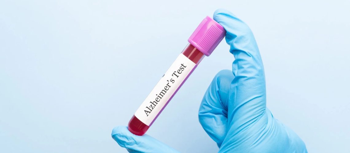 Blood sample tube with Alzheimer test label on medical laboratory technologist hands over blue background