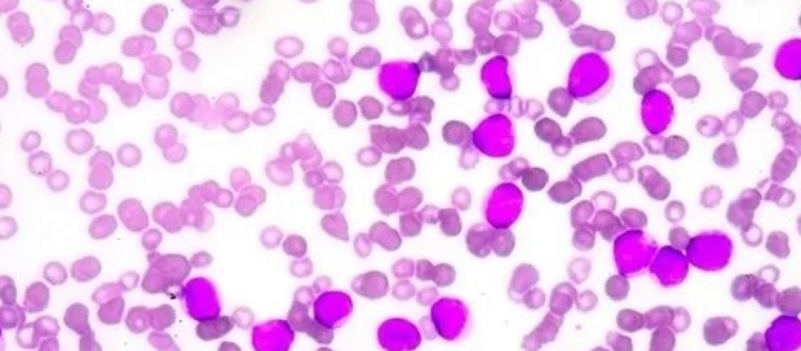 חולי אנמיה של Fanconi מראים הבדלים מטבוליים בולטים