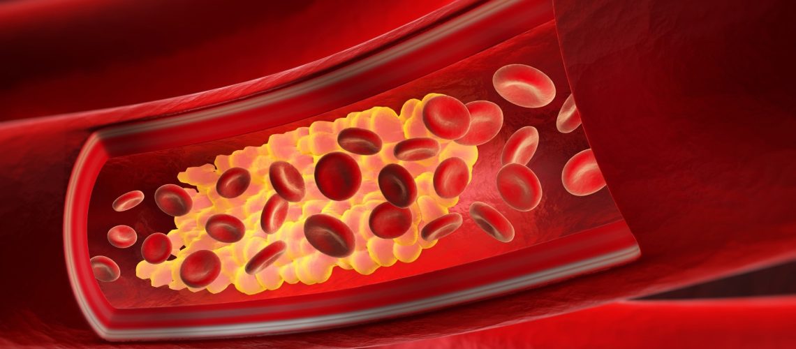 חומר הפרעות RNA plozasiran מכוון ל-APOC3 לטיפול יעיל בעור שומנים בדם