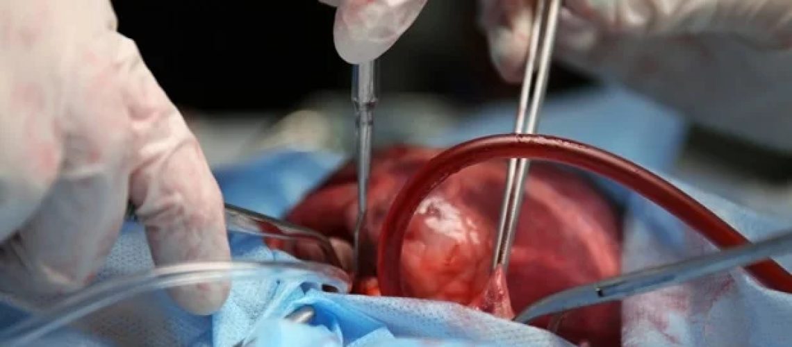 חוקרים מבצעים בהצלחה מעקף עורק כלילי מבלי לחתוך את דופן בית החזה