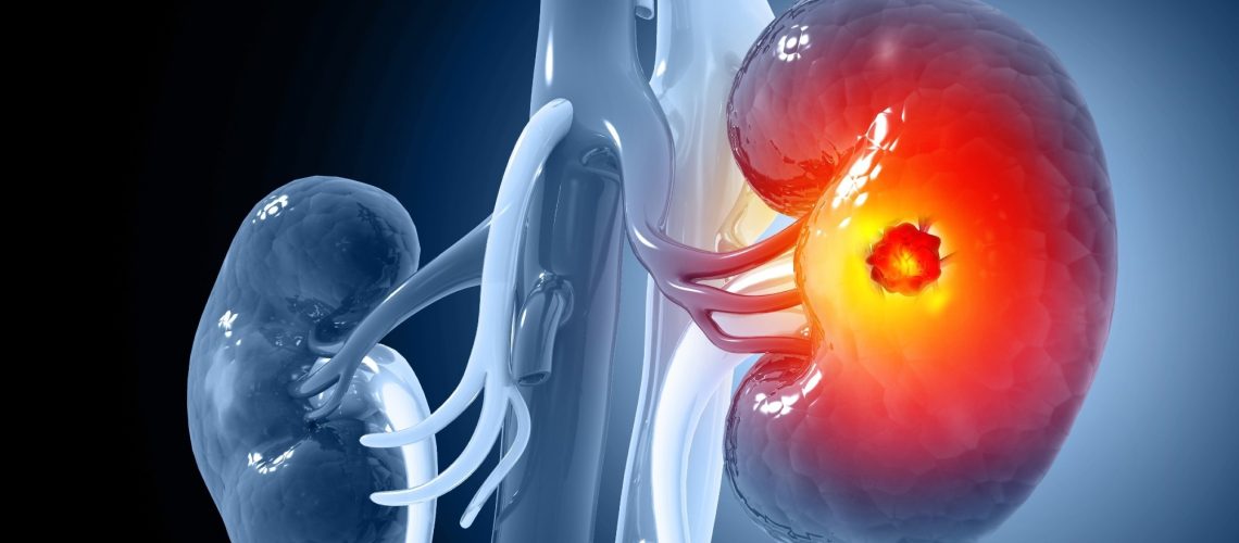 Study: A neoantigen vaccine generates antitumour immunity in renal cell carcinoma. Image Credit: crystal light / Shutterstock