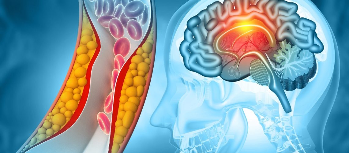 Study: Inhibition of GAPDH aggregation as a potential treatment for acute ischemic stroke. Image Credit: crystal light / Shutterstock