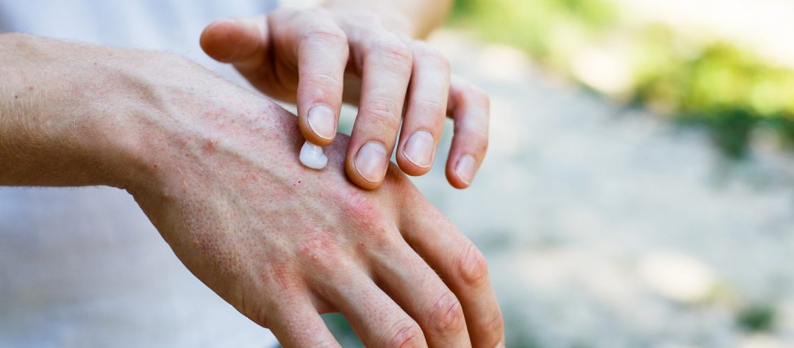 Study: Exposure to Air Pollution, Genetic Susceptibility, and Psoriasis Risk in the UK. Image Credit: Ternavskaia Olga Alibec / Shutterstock