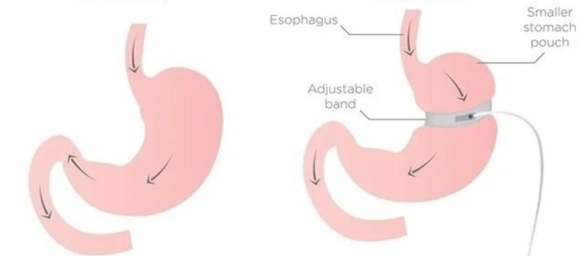 חשיפת PFAS מעלה את הסיכון למשקל מחדש לאחר ניתוח בריאטרי מתבגר