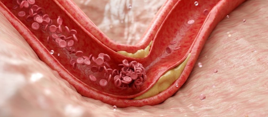 Study: Immune checkpoint landscape of human atherosclerosis and influence of cardiometabolic factors. Image Credit: Piyaset/Shutterstock.com