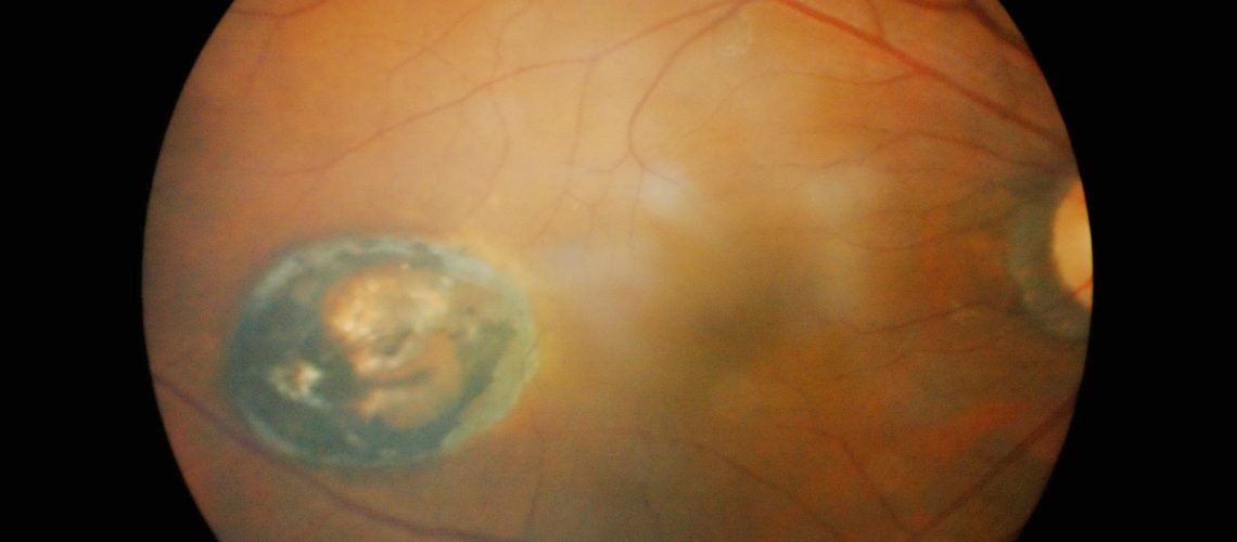 Study: Therapeutic targeting of cellular senescence in diabetic macular edema: preclinical and phase 1 trial results. Image Credit: Anukool Manoton / Shutterstock
