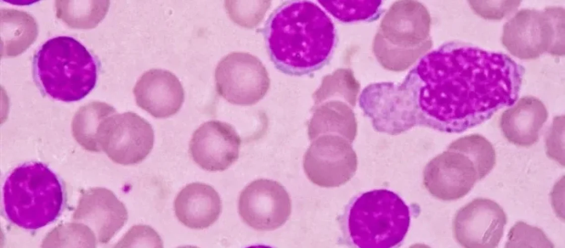 טיפול משך זמן קבוע פועל ביעילות כמו טיפול מתמשך בלוקמיה לימפוציטית כרונית