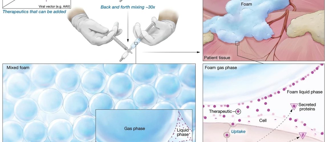 Schematic illustration depicting how gene therapy foam is freshly prepared and applied therapeutically to supply new genetic material or change existing DNA in cells. A Nonviral or viral vector (Therapeutic) is added to foam precursor in a syringe connected to a second syringe filled with air. The air and foam precursor are mixed by vigorously drawing the syringe plungers back and forth at least 30 times, creating a uniform microfoam consisting of gas bubbles separated by a network of interconnected liquid film structures called lamellae. Gene therapy vectors are concentrated in this liquid phase as the foam matures. B Once applied to tissue, the foam gradually deploys its therapeutic cargo and either supplies new genetic material or changes the endogenous DNA in the target cell. Study: Liquid foam improves potency and safety of gene therapy vectors
